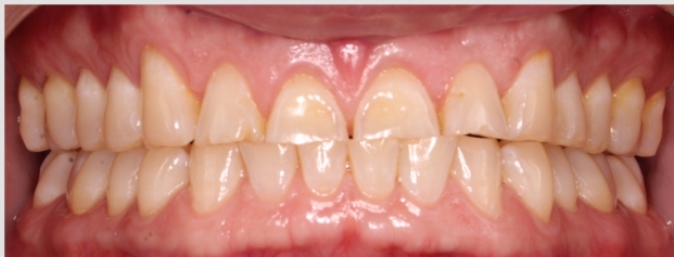 After image