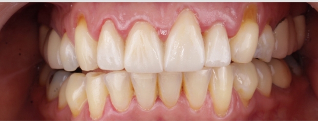 After image