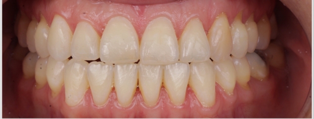 After image